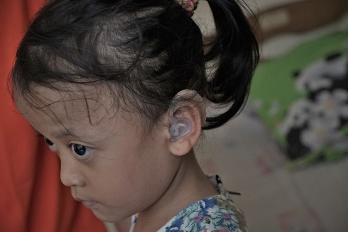 program humanusia salurkan alat bantu dengar untuk Azkadina